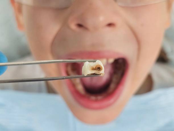 Best Emergency Broken Tooth Repair in Floydada, TX