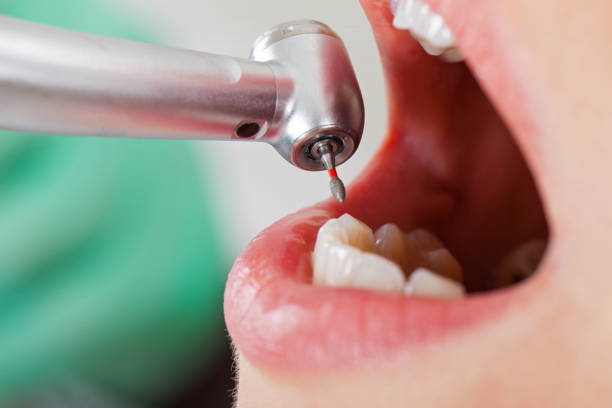 Best Emergency Wisdom Teeth Removal in Floydada, TX